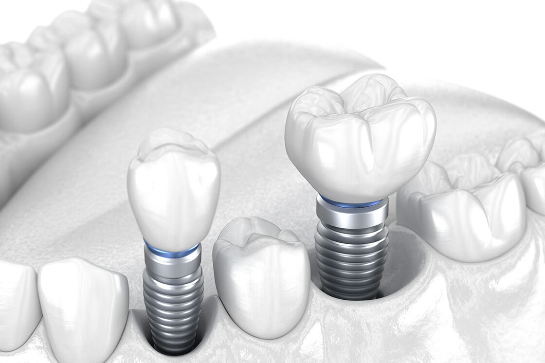 Implant_Crowns_Bridges