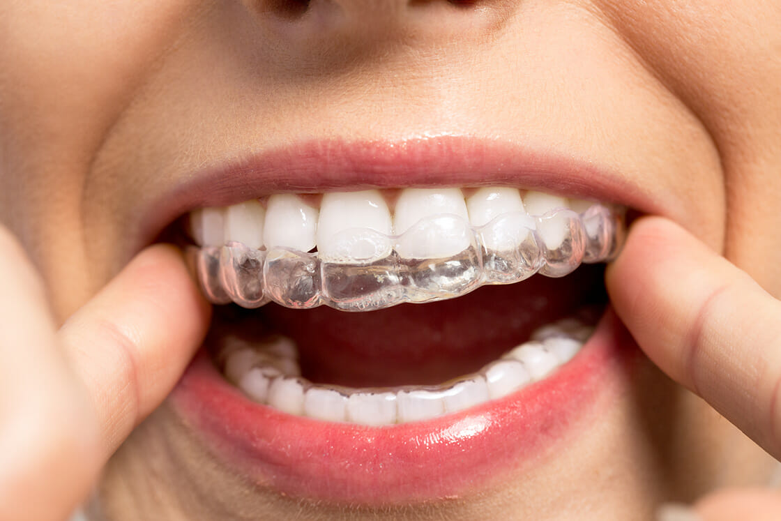 invisalign at home