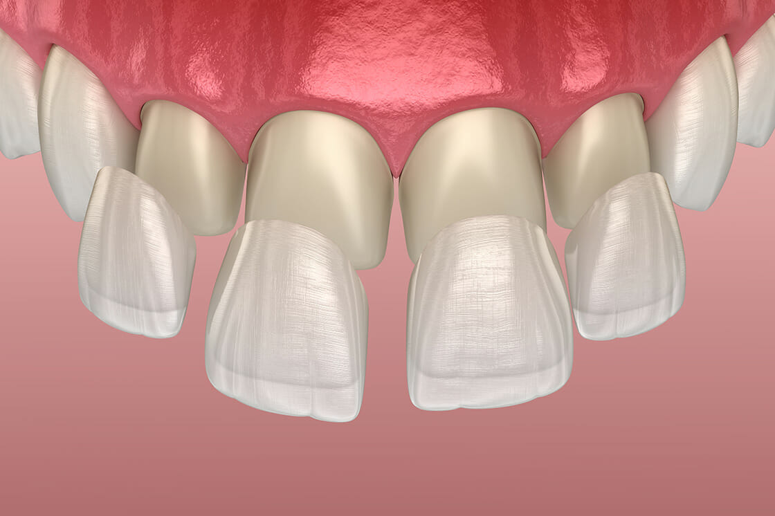 porcelain veneers