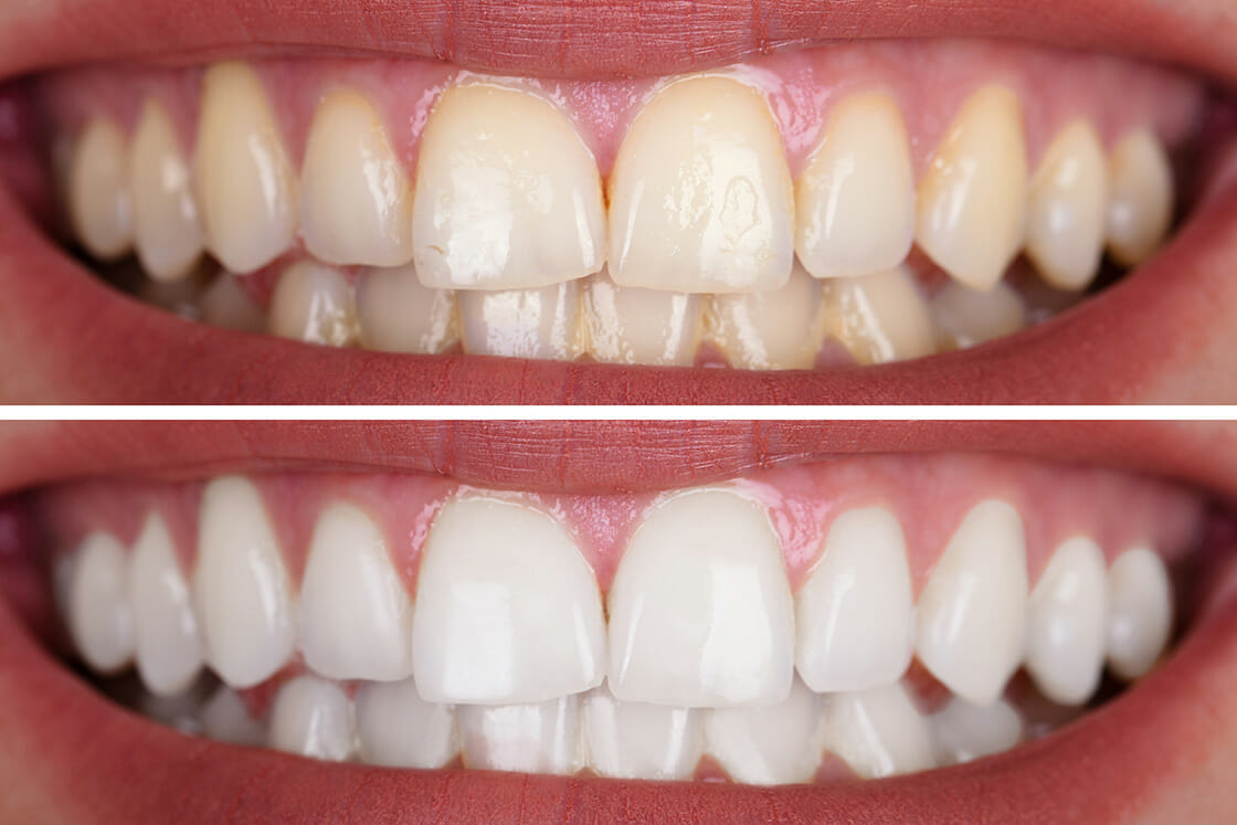 Teeth_Whitening_pic