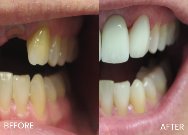 dental crown and veneers