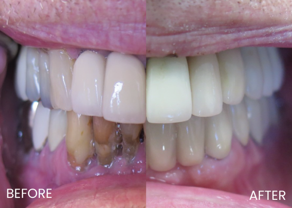 bridge and whitening before and after