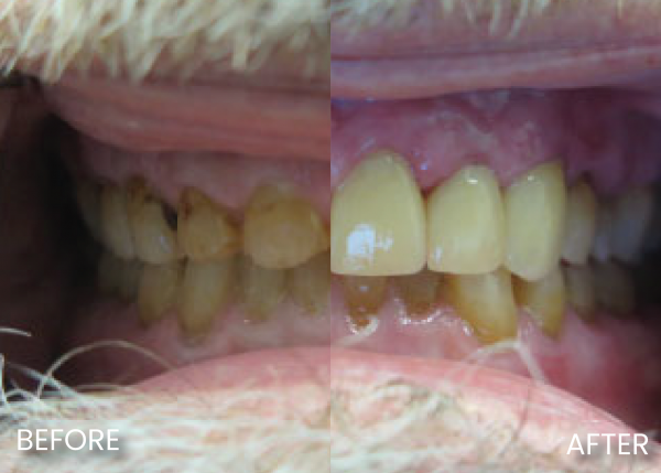 before and after dental crowns