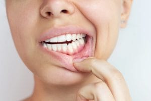 What Cincinnati Patients Should Know About Periodontal Therapy and Long-Term Gum Health