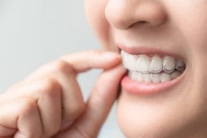 Invisalign in Cincinnati for Adults Seeking Straighter Teeth